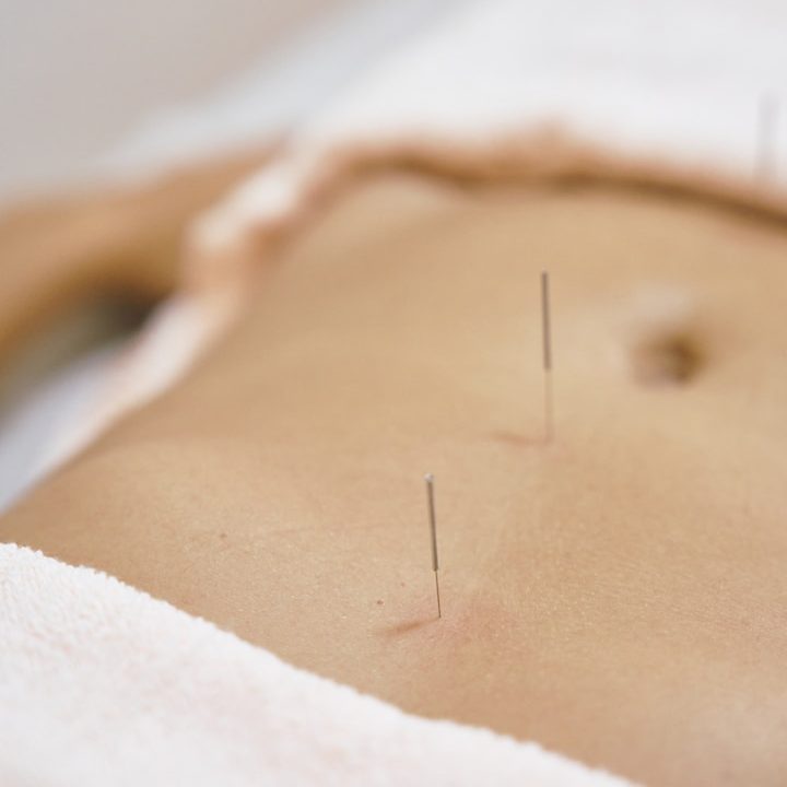 2 Akupunkturnadeln im Bauch einer Patientin